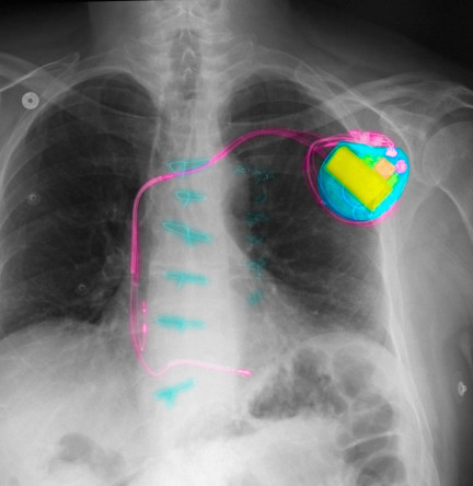 chest x-ray showing a pacemaker